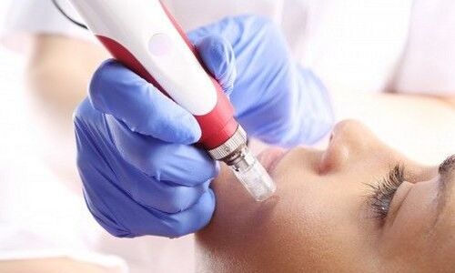 Microneedling - Dermapen